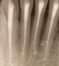 Полноценно запломбированные корневые каналы зубов